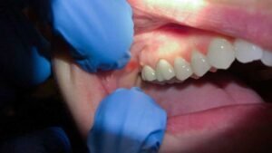 Dental Abscess