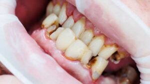 Dental Erosion