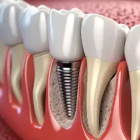 Dental Implants