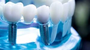 Journey of dental implants