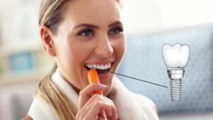 Dental Implants Revolutionize Your Quality of Life