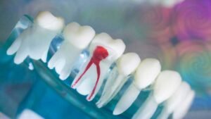 Understanding Root Canal Therapy