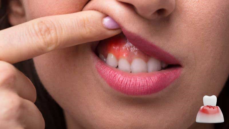 Gum Disease - Causes and Prevention