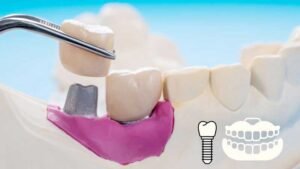 Dental Implants vs Other Options