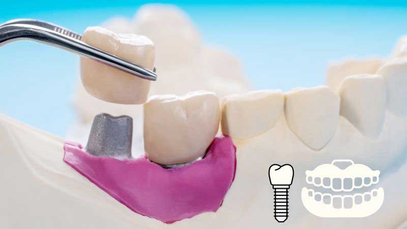 Dental Implants vs Other Options