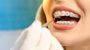 How much do braces cost in Australia