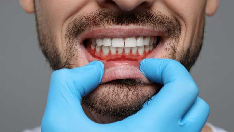 You Can Keep Gum Disease at Bay