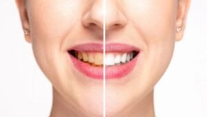 Teeth whitening cost in Australia