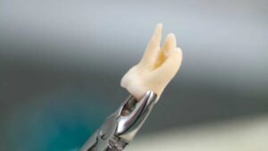 Wisdom Teeth: To Remove or Not to Remove