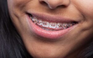 orthodontic treatment