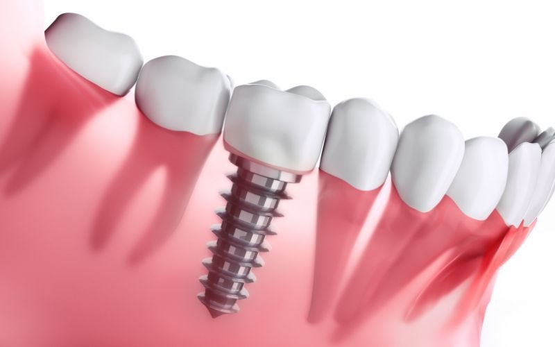 Dental Implants vs. Dentures