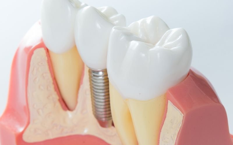 Dental Implants vs. Dentures